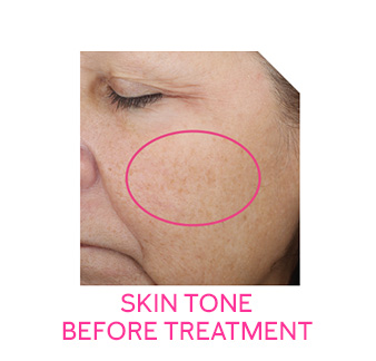 Image of cheek before eight-week retinization process with Mary Kay Clinical Solutions® Retinol 0.5 Set